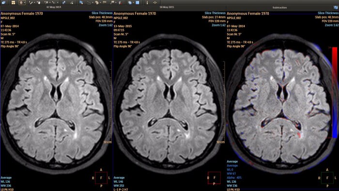 longitudinal brain imaging por RM