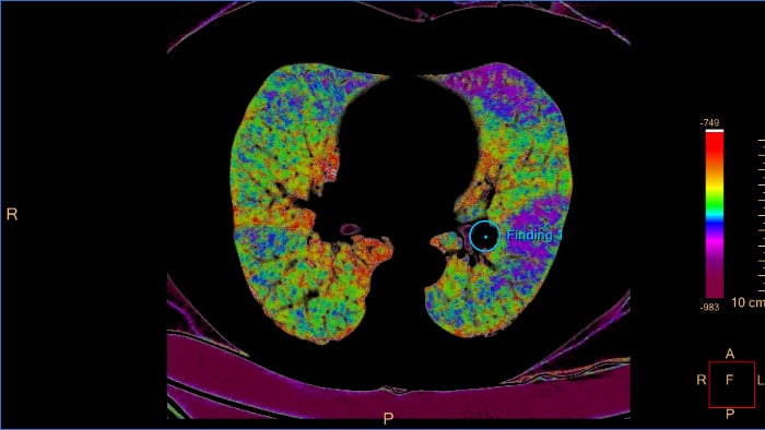 Mapa de cores CB da análise das artérias pulmonares por CT