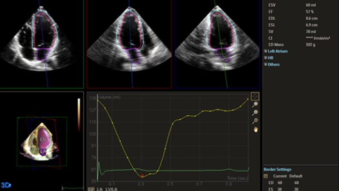 Imagem mostrando quantificação através do Philips Dynamic HeartModel