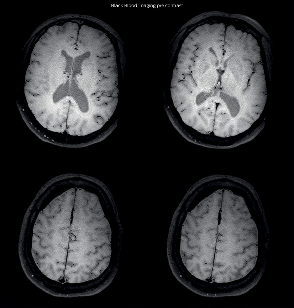 Black blood imaging pre contrast