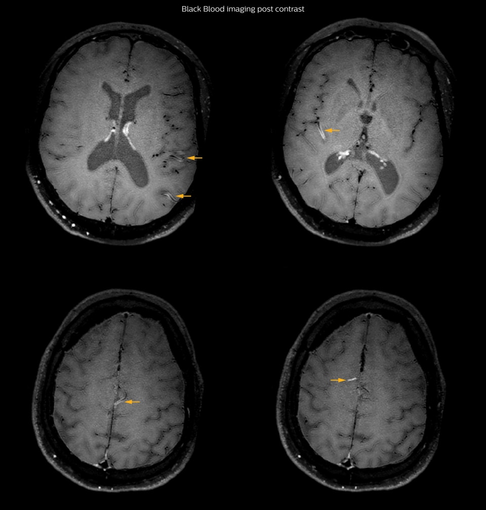 Black blood imaging post contrast