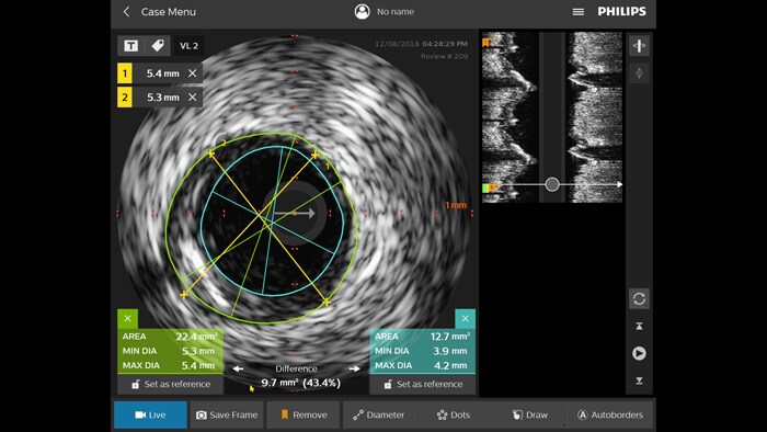 Ultrassom intravascular (IVUS)