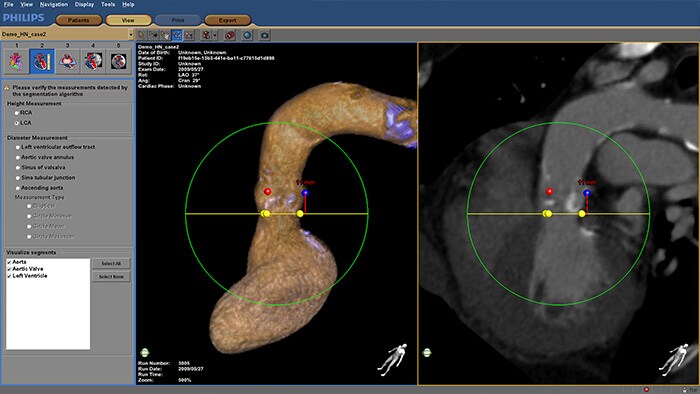 Procedimento com o HeartNavigator