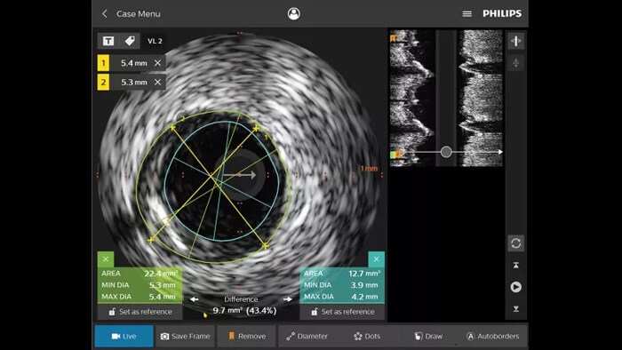 Angiograma no IntraSight