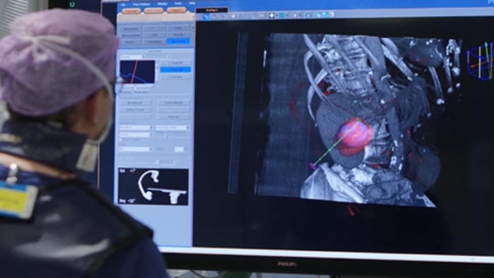 Biópsia e ablação de tumores