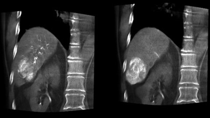 Visualização de artéria e tumor otimizada com a CBCT Dupla