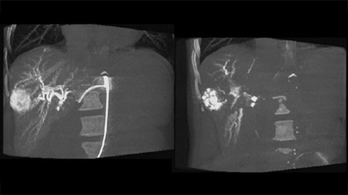 Diagnóstico por imagem 3D pós-embolização com CBCT