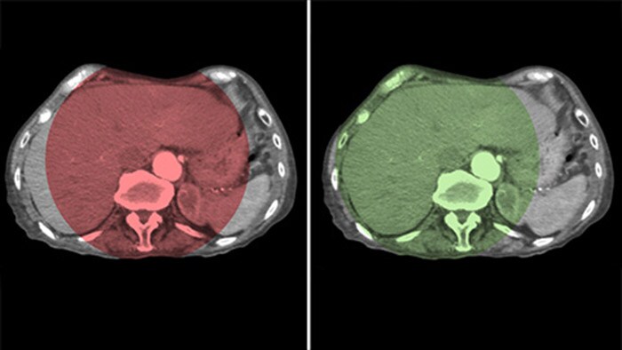 Cobertura total do fígado com a CBCT Aberta