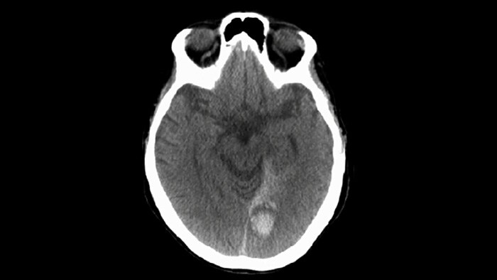 CBCT (semelhante à TC)