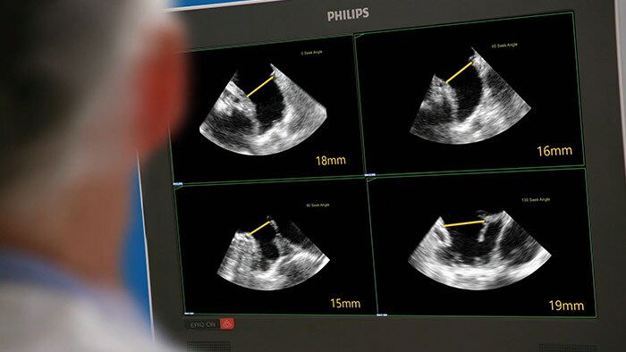 Sistema de ultrassom intervencionista EPIQ CVxi