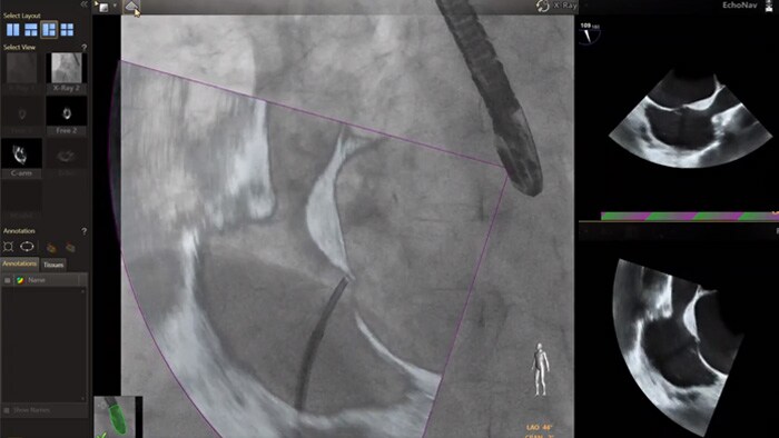 Modelos de válvula mitral e aórtica do EchoNav