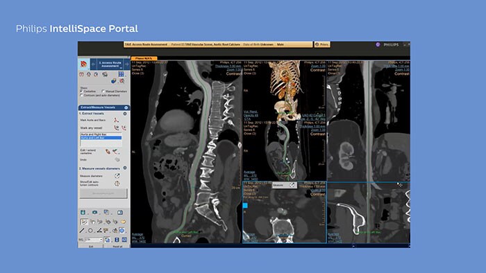 Planejamento de TAVI no Portal IntelliSpace