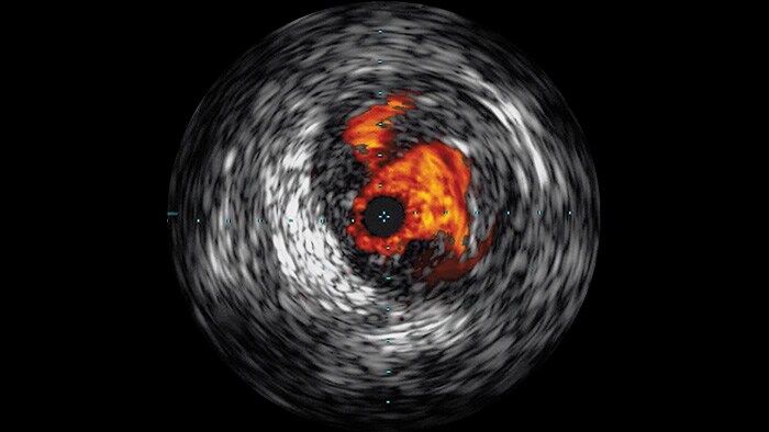 Ultrassom Intravascular (IVUS)