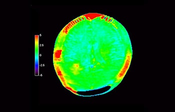 Reincidência de glioblastoma