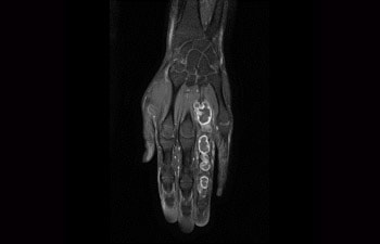 Mão/pulso com tumor