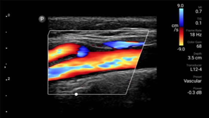 Miniatura vascular