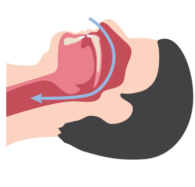 Vias respiratórias não obstruídas e obstruídas