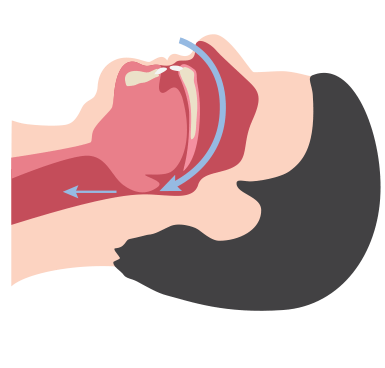 Vias respiratórias não obstruídas e obstruídas