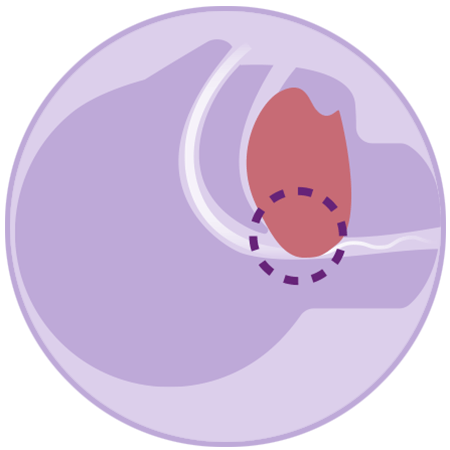 Obstructed airway