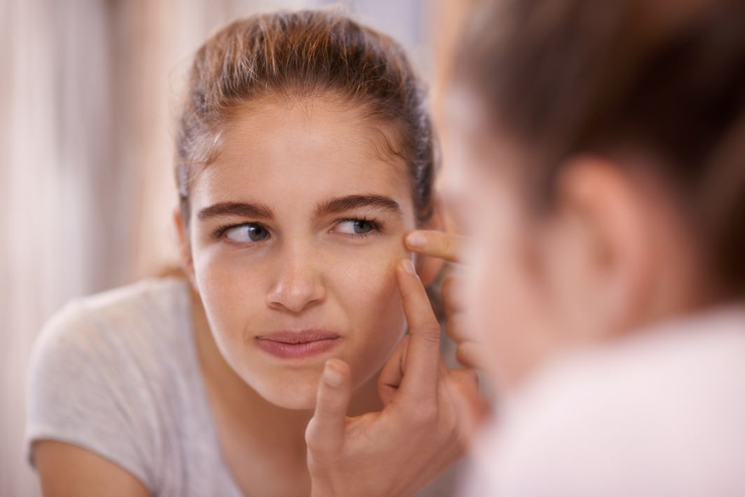 Comidas e bebidas para evitar com a acne