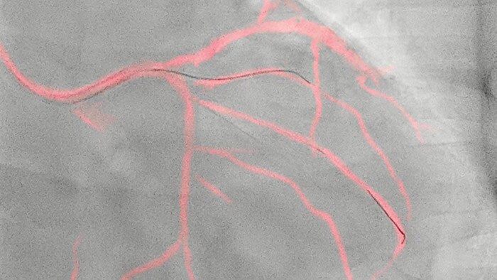 A navegação guiada por imagem da Philips aumenta a segurança durante intervenções coronárias e reduz o uso de meios de contraste em uma média de 28,8%
