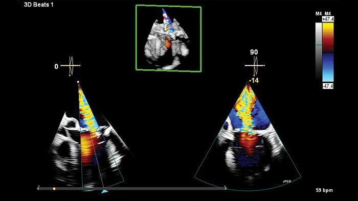 Mini 3D TEE transducer clinical view